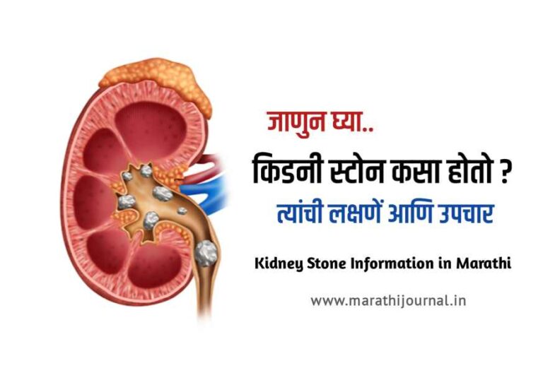 Kidney stone marathi 1